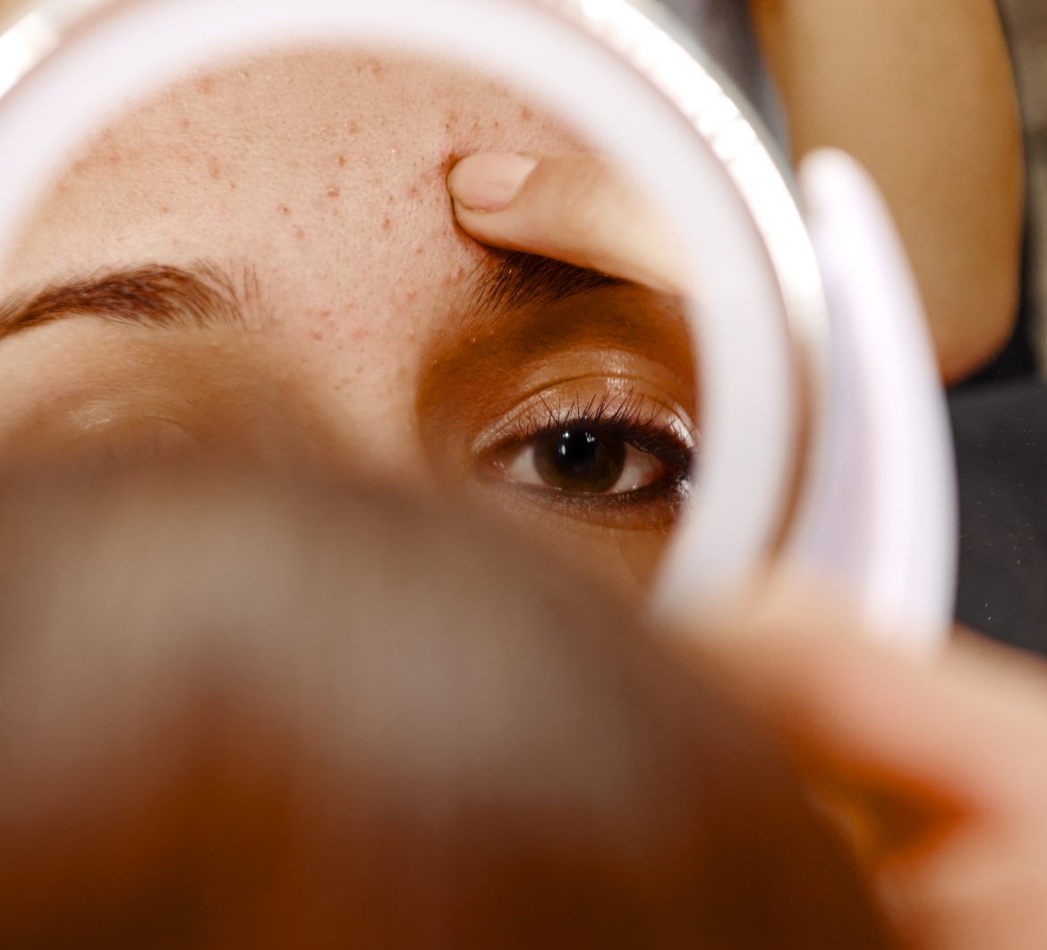 5 winter skincare tips for acne prone skin