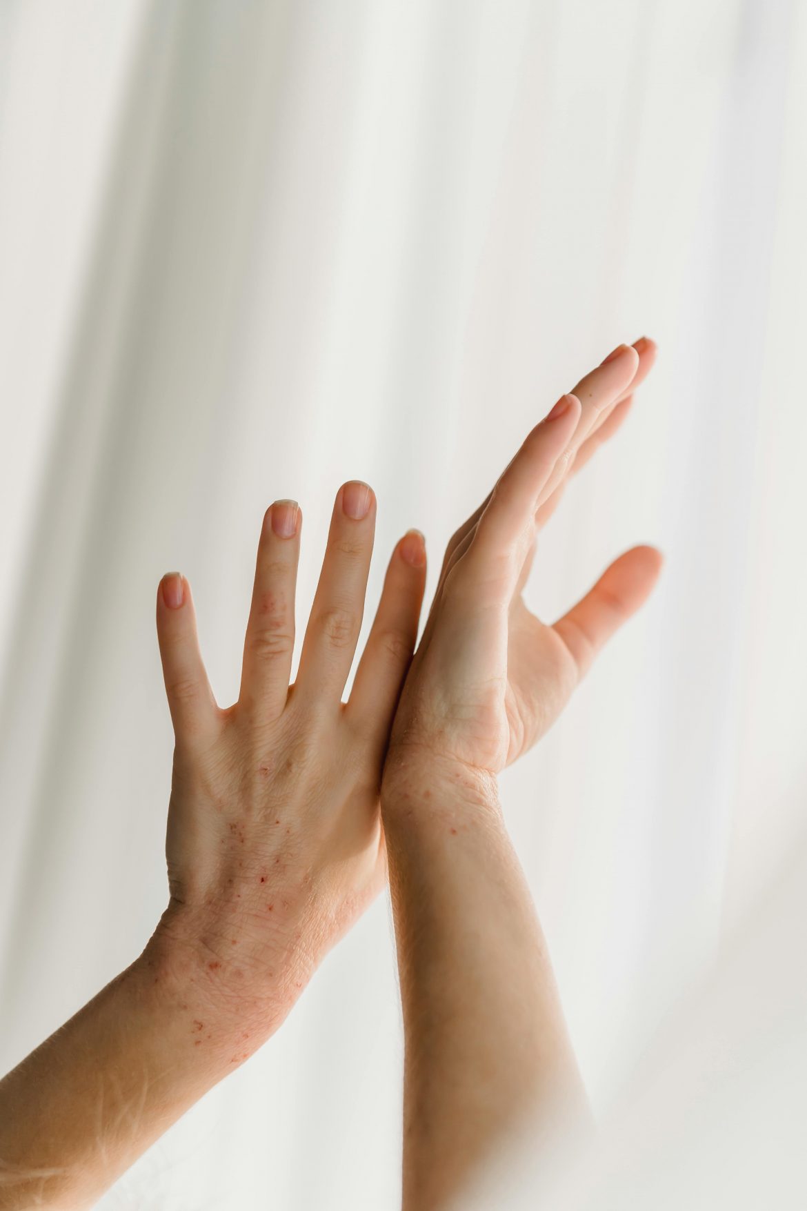 5 holistic remedies to treat psoriasis