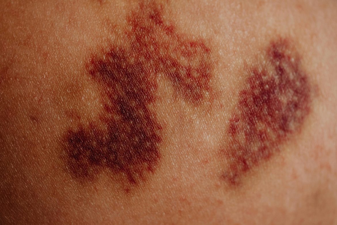 What is blood pooling and what can you do about it?