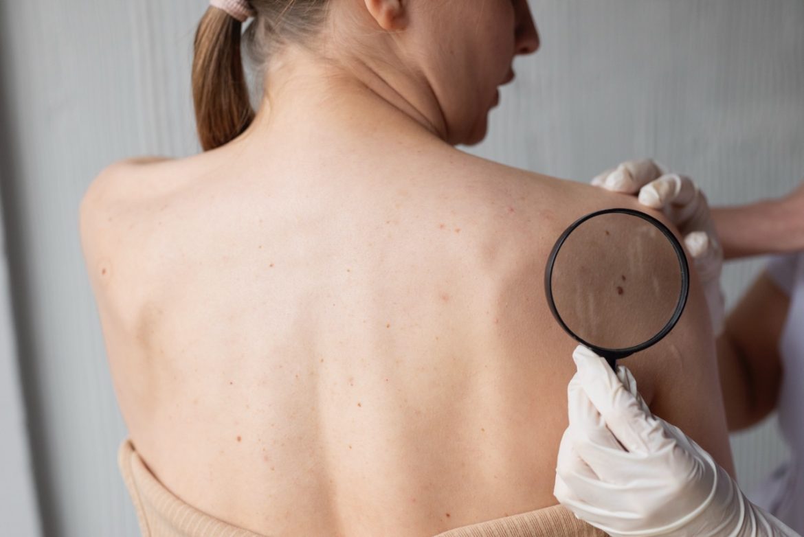 Signs of melanoma every woman should look for